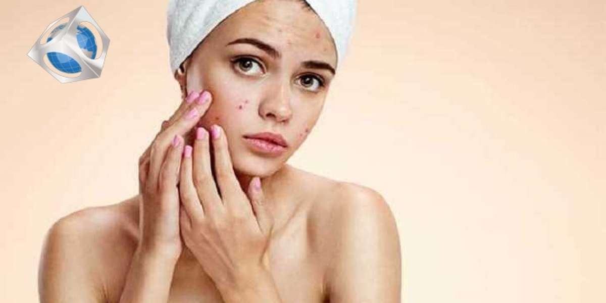 Top six home treatments for oily skin