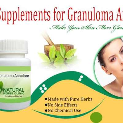 Buy Herbal Supplements to Get Rid of Granuloma Annulare Completely Profile Picture