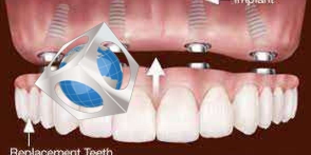 Dental Implants - Types and Procedures