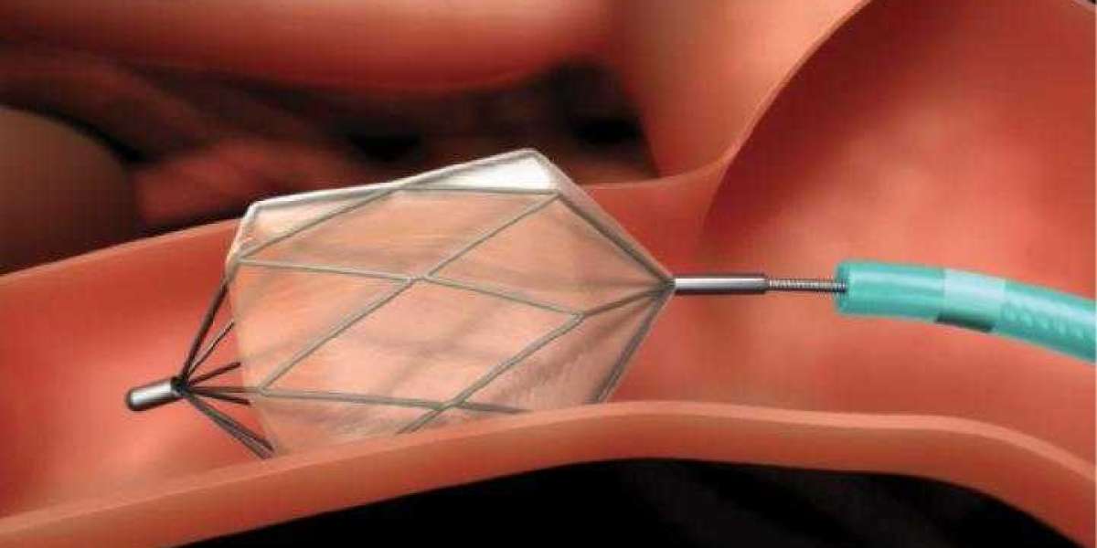 Transcatheter Embolization And Occlusion Devices Market Trends by Key Players, End User, Demand, Analysis Growth and For
