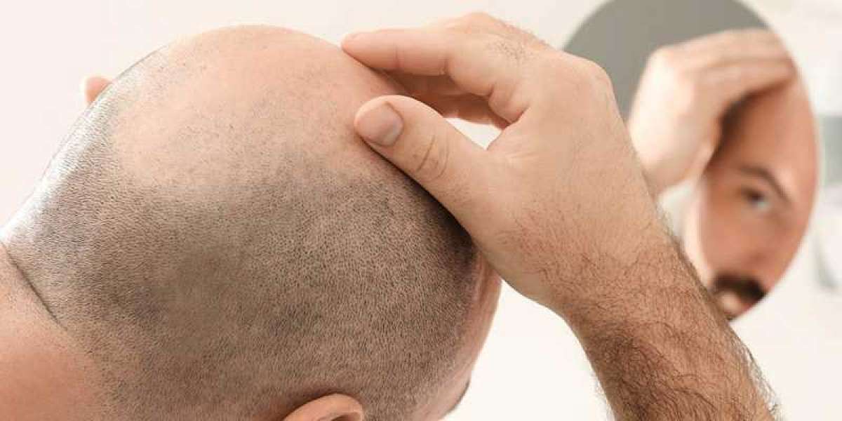 Hair Transplant: A Comprehensive Guide