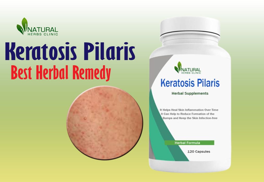 Natural Treatment for Keratosis Pilaris: Unveiling the Power of Cod Liver Oil | by walamdavid | Sep, 2023 | Medium