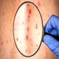 Understanding Chickenpox: Symptoms, Causes, Diagnosis, and...