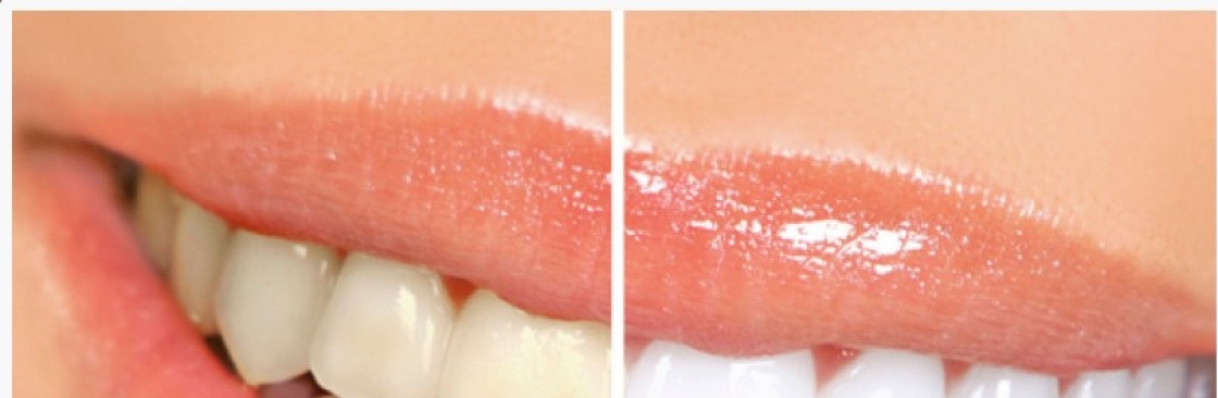 Denta pex Cover Image